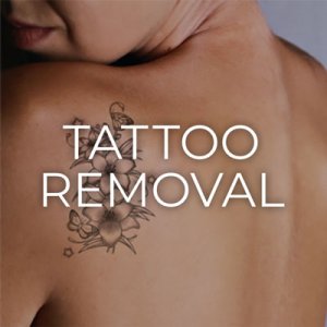 Tattoo Removal in Albuquerque, NM