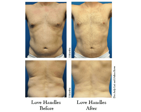 Smart Lipo Before and After