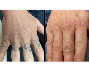 Hand Tattoo Removal in Albuquerque