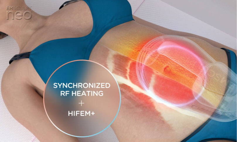 Emsculpt NEO uses synchronized RF Heating and HIFEM+