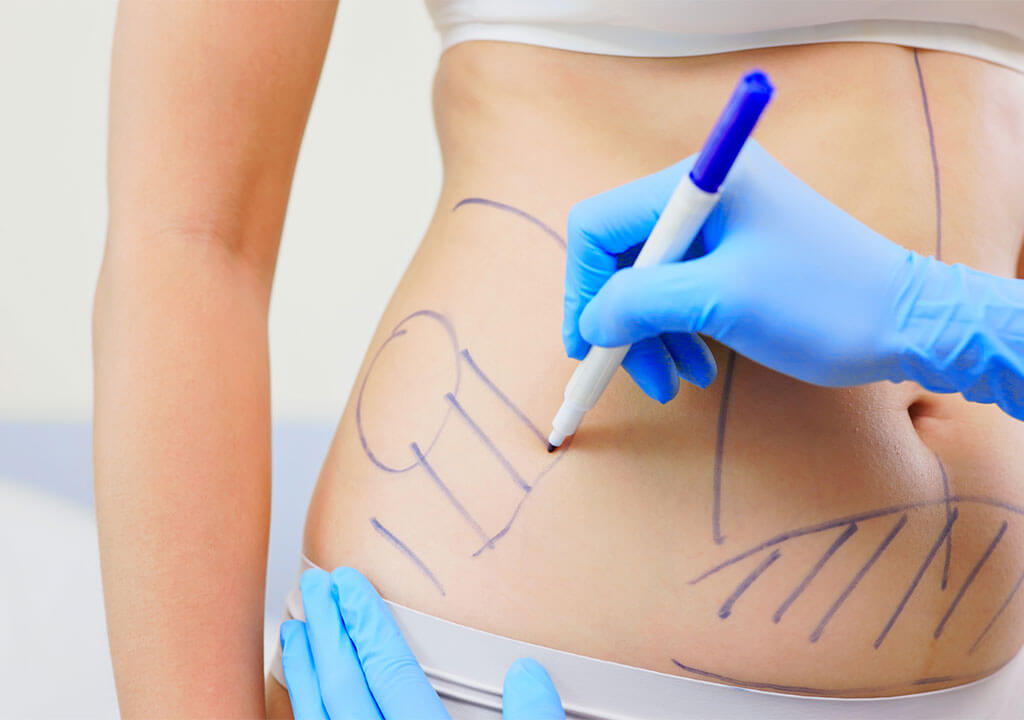 Plastic surgery as a body contouring option