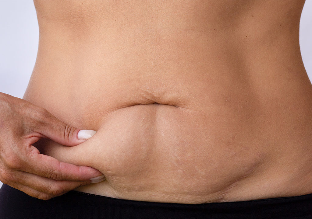 Loose skin and subcutaneous fat in the midsection